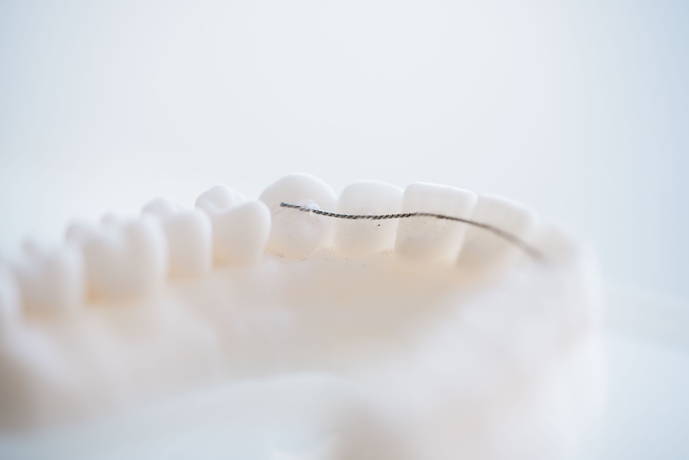 pham-miehe-privatpraxis-invisalign-duesseldorf-retainer-v1 pham-miehe- privatpraxis-invisalign-duesseldorf-retainer-v1